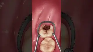 給爛牙補個牙 一分鐘看完補牙全過程 #dentist #牙齒 #口腔健康