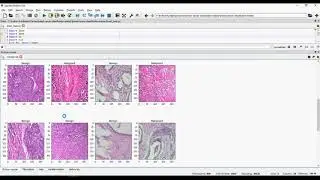 Breast Cancer Classification Using Python