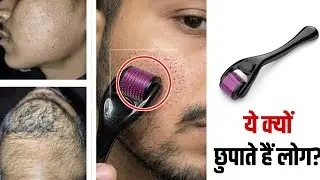 Best Derma Roller For Beard Growth Explained | Derma Roller For Beard Growth 2026 |