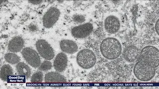 NYC Monkeypox outbreak