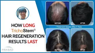 How TrichoStem Hair Regeneration Outlasts Other Hair Loss Treatments