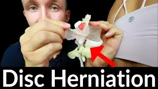 NO MORE Disc Pain! | Disc Herniation Pain Sitting Long Periods | Fix Your Low Back