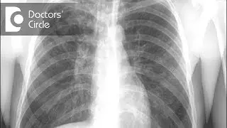 How to manage Tuberculosis of bone & lungs? - Dr. Sanjay Panicker