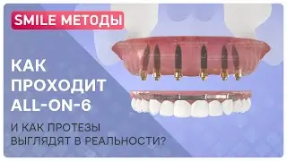 Что такое all-on-6? Видео об имплантации на 6 имплантах, как смотрятся протезы