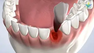Tooth Extraction in Dallas TX: Dr. Phillips | Park Cities Oral & Maxillofacial Surgery Associates