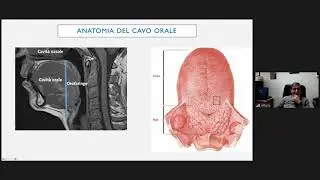 21.6) Le patologie neoplastiche del cavo orale - Prof. Arturo Brunetti