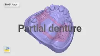 Dise&ntilde;ando una estructura para una Protesis Parcial Removible con Medit Design App