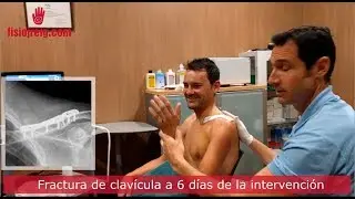 Fractura de clav&iacute;cula, recuperaci&oacute;n de Rafa Valls a los 6 d&iacute;as de la intervenci&oacute;n