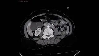  A large mass lesion in the right lobe of liver. Hepatocellular carcinoma (HCC) #radiology #ctscan 
