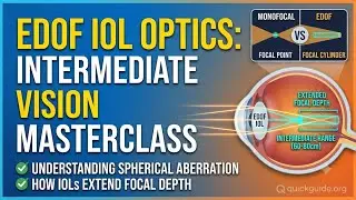 How EDOF Optics Control Spherical Aberration for IOLs⁠