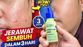 FULL REVIEW SCORA ACNE SERUM