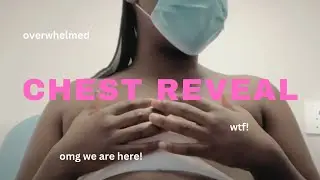 Trans Top Surgery Reveal: No Nipple Grafts! | Non-Binary Black Journey