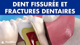 DENTS CASS&Eacute;ES - Sympt&ocirc;mes et types: dents fissur&eacute;es et fractures dentaires &copy;