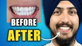 The REAL Difference Between Braces and Invisalign for a Perfect Smile