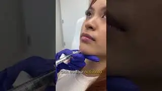 Chin Filler for Facial Harmony | Natural Profile Enhancement at Enfield Royal Houston