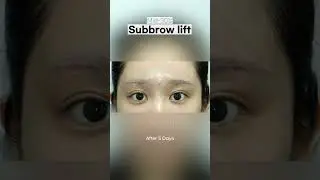 Asymmetrical Eyelid Correction: Subbrow Lift Surgery #DrKwakMinho #dasipium #facelift #SubbrowLift