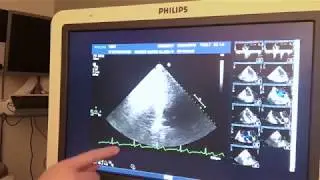 Adult Echocardiogram on Philips IE33