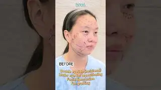 NOW I look younger than my age/ NANA plastic Surgery Hospital