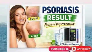 How Kangen Water Helped in Psoriasis | Real Life Result | Water Healing Experience #enagic #kangen 