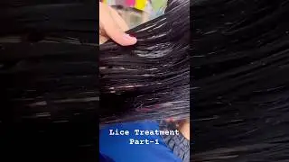 Lice removal treatment in Telugu| part-1 #shorts #liceremoval #licecomb #licecombing