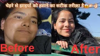 चेहरे की पुरानी सी पुरानी झाइयाँ कैसे करें ठीक ✅ ॥ #hyperpigmentation #melasma #tranding