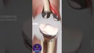 Total Knee Replacement | Restoring Smooth Movement in the Knee