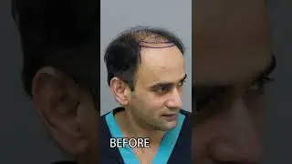GET YOUR HAIR BACK - HAIR TRANSPLANT 9 MONTHS RESULT
