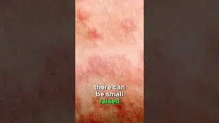 Measles rash explained | #health #measles #doctor #MMR #vaccine #publichealth