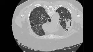 Mycetoma in UIP on chest CT (HRCT)