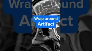 MRI Wrap-Around Artifact in 76 seconds &ndash; Why It Happens and How to Fix It