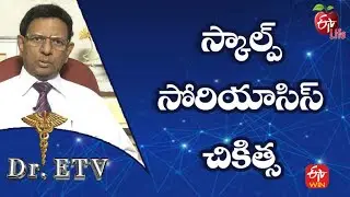 Scalp Psoriasis - Treatment | స్కాల్ప్ సోరియాసిస్‌ - చికిత్స | Dr.ETV | 12th Sep 2022 | ETV Life