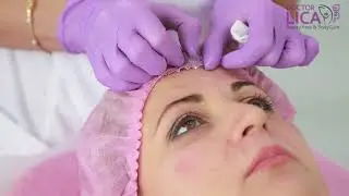 Glabela (frown) lines treatment with PRESSENSA ATTRACTIVA