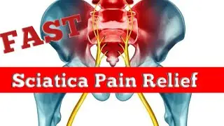Sciatica | Causes and Treatment of Sciatica | how to prevent from Sciatica | Urdu/Hindi