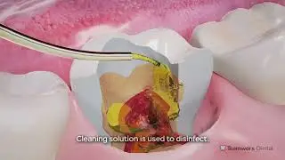 Pulpotomy with Stainless Steel Crown