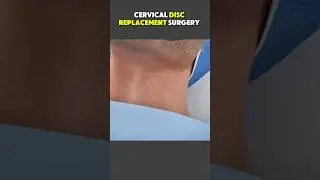 Cervical_Disc_Replacement_Surgery__3D_Animation__#discreplacement_#discreplacementsurgery_#cervical