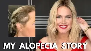 MY ALOPECIA STORY