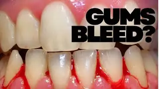 Why Your Gums Bleed When You Brush (And What It Means)