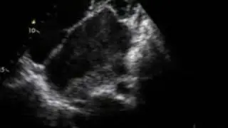 Spontaneous echocontrast with Left Atrial Thrombi- 3D echo
