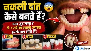 Bridge | RPD | Fixed Teeth &ndash; UjoDent Lab में दांत कैसे तैयार होते हैं? Best Quality और सच्ची जानकारी