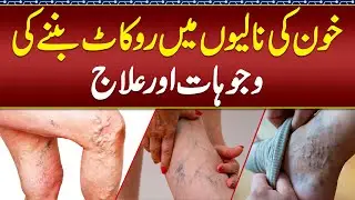 Varicose Veins Treatment in Pakistan- Varicose Veins Surgery- Khoon Ki Nalion Ko Saf Karne Ka Tarika