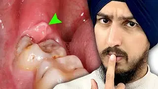 What Does This Swollen Gum Flap Mean?
