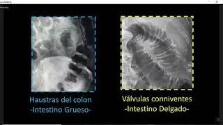OBSTRUCCION INTESTINAL FULL