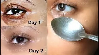 How to Remove Under Eye WRINKLES, Under Eye Bags, Puffy eyes & Dark Circles in 1 Day with ice cubes