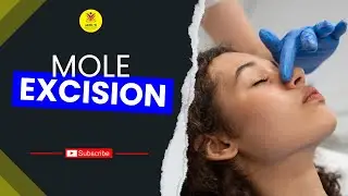 Expert Mole Removal Procedure | Best Mole Removal Treatment in Durgapur | Best Mole Removal Result