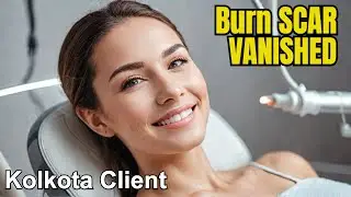 Kolkata Client 🔥 Burn Scar Gone with 6-in-1 Laser Combo | Best Scar Treatment at Kayakalp Clinic