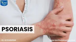 PSORIASIS   -Homeopathy Treatment Drkukreja kalani online consultation 8291492566
