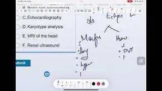 Lens Dislocation Dramaaa! When Ectopia Lentis Says &lsquo;Surprise!&rsquo; Marfan Syndrom &lsquo;Check My Aorta First&rsquo;