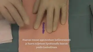 Haavan liimaus