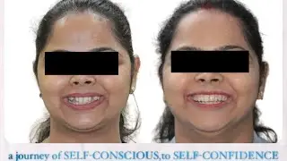 Impacted canine braces treatment / Before and After / case presentation. Orthodontic treatment.