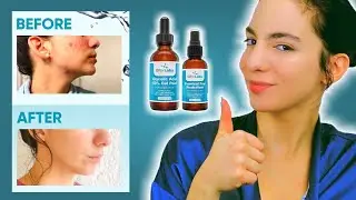 Eliminate Acne Scars with (at home) Glycolic Acid 50% Gel Peel